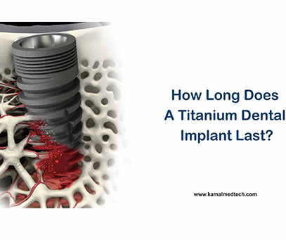 how-long-a-titanium-dental-implant-last