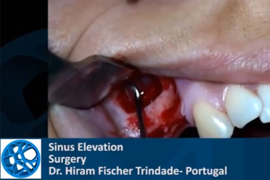 sinus-elevation-dr-hiram-fischer-using-medbone