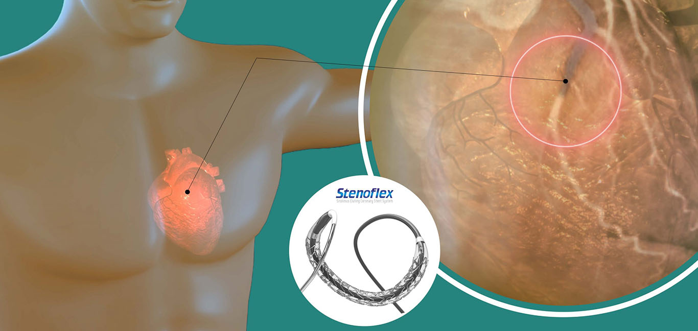 coronary-angioplasty-and-stenting-procedure