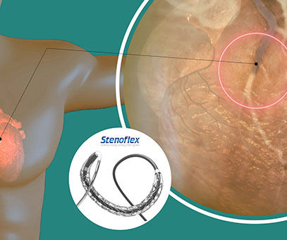 coronary-angioplasty-and-stenting-procedure