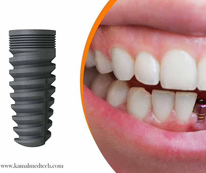 dental-implant-surgery-recovery
