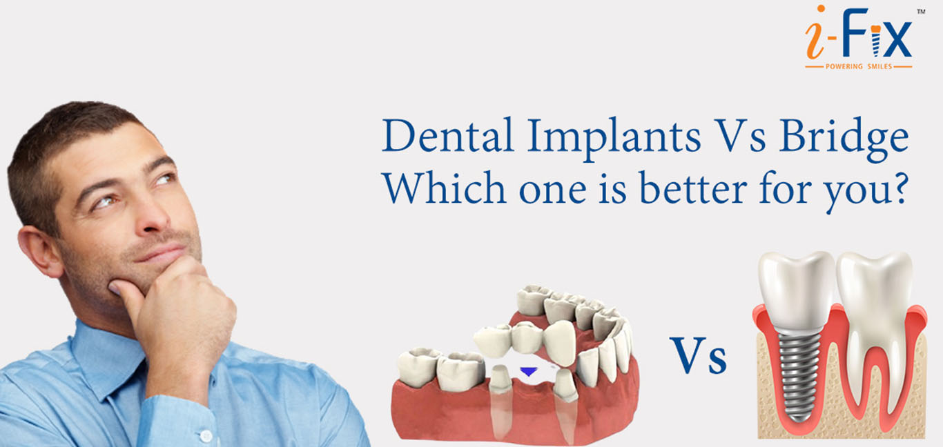dental-implants-vs-bridge-which-one-is-better-for-you