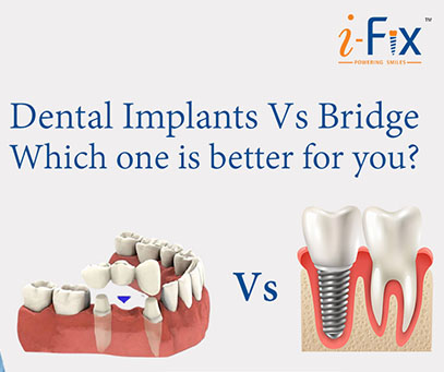 dental-implants-vs-bridge-which-one-is-better-for-you