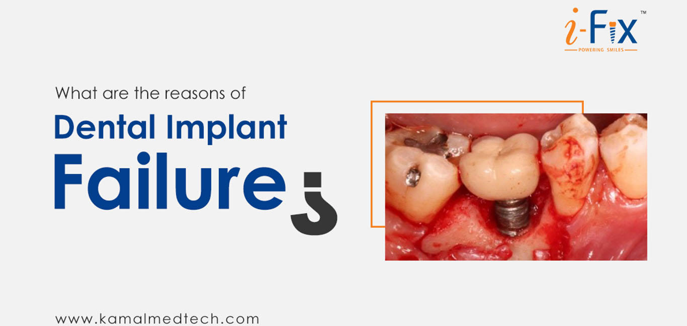reasons-for-failure-of-dental-implant