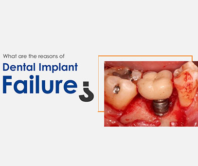 reasons-for-failure-of-dental-implant