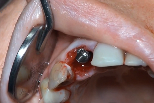 medbone-immediate-loading-implant-using-adbone-tcp